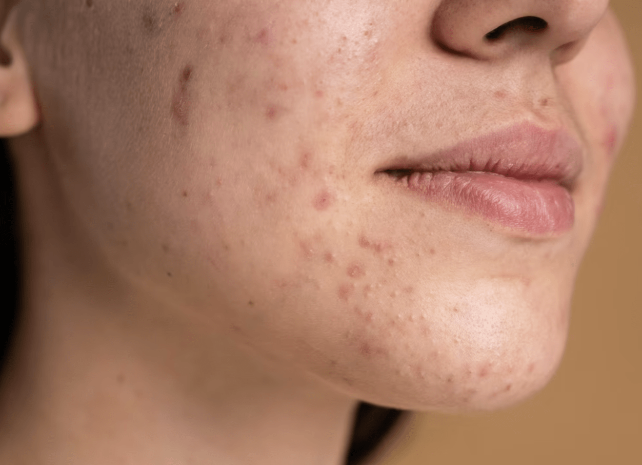 Rahasia Ampuh untuk Kulit Cantik Tanpa Operasi! Yuk Simak Cara Alami Mengatasi Pori-pori Besar