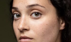 Cara Terampuh Mengatasi Flek Hitam Kulit, Anda Tak Akan Percaya Hasilnya!