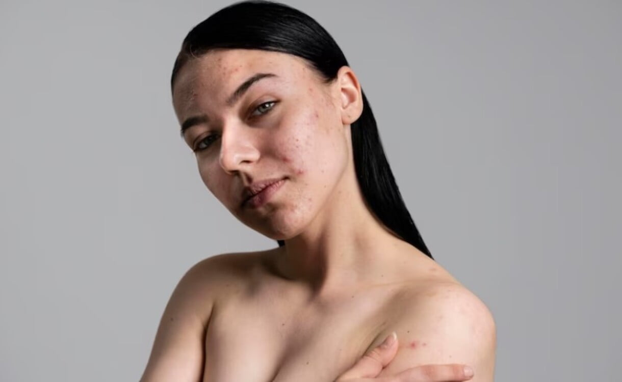 Rahasia Tersembunyi Menghilangkan Flek Hitam di Wajah dengan Cepat Menggunakan Rahasia Air Mawar dan 2 Bahan Ajaib Ini!