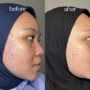 5 Keajaiban Sereh dalam Dunia Kecantikan Jerawat Teratasi, Ketombe Lenyap!
