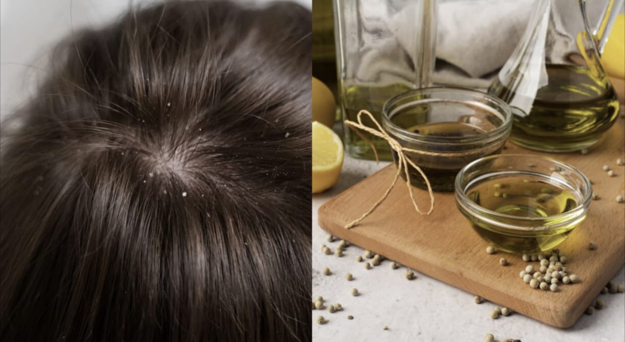 Cara Ampuh Mengatasi Ketombe dengan Minyak Zaitun dan Jeruk Nipis Sebagai Conditioner, Manfaatnya untuk Menghilangkan Gatal pada Kulit Kepala!