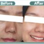 Flek Hitam Akan Rontok dengan Cepat Setelah Pemakaian! Inilah 5 Produk Skincare yang Efektif untuk Menghilangkan Flek Hitam dalam Sekejap