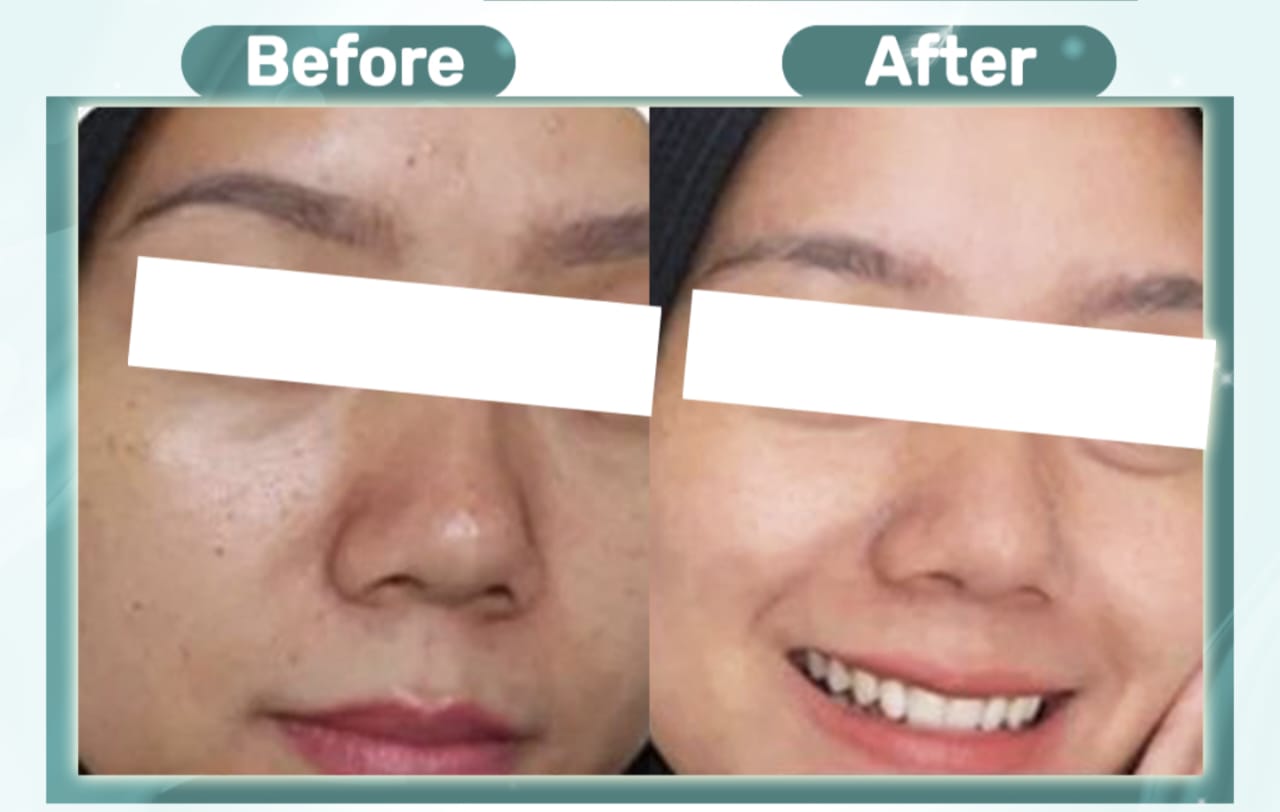 Flek Hitam Akan Rontok dengan Cepat Setelah Pemakaian! Inilah 5 Produk Skincare yang Efektif untuk Menghilangkan Flek Hitam dalam Sekejap