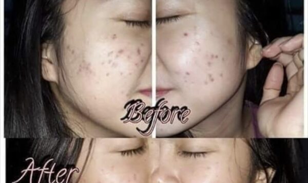 Kopi Terbukti Efektif Mengatasi Jerawat yang Sulit Dihapus, Kulit Wajah Anda Akan Bersinar!