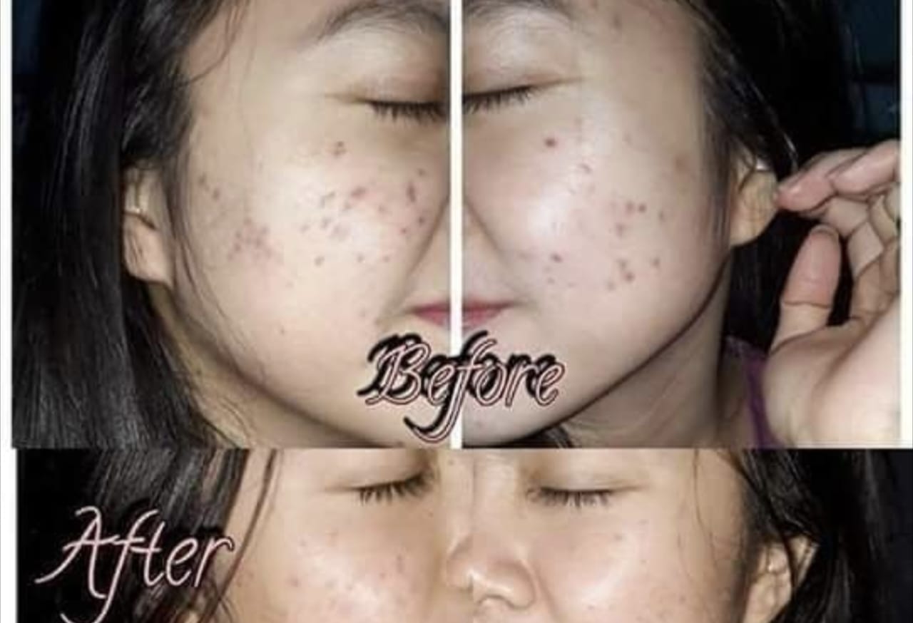 Kopi Terbukti Efektif Mengatasi Jerawat yang Sulit Dihapus, Kulit Wajah Anda Akan Bersinar!