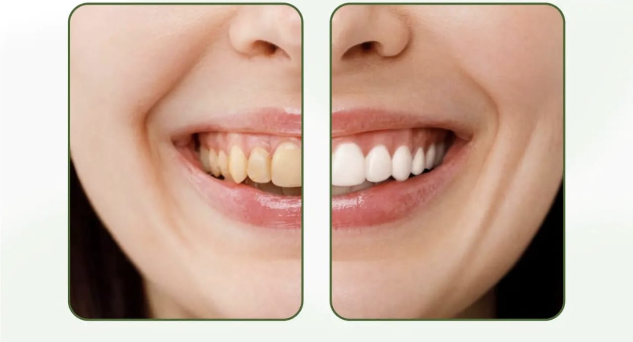 Putihkan Gigi Kuning yang Penuh Plak dalam 15 Menit dengan Bantuan 1 Rempah Dapur