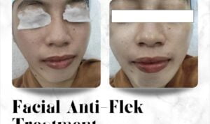 Ternyata, Inilah 4 Produk Perawatan Kulit yang Efektif untuk Mengatasi Flek Hitam dan Mencerahkan Wajah!