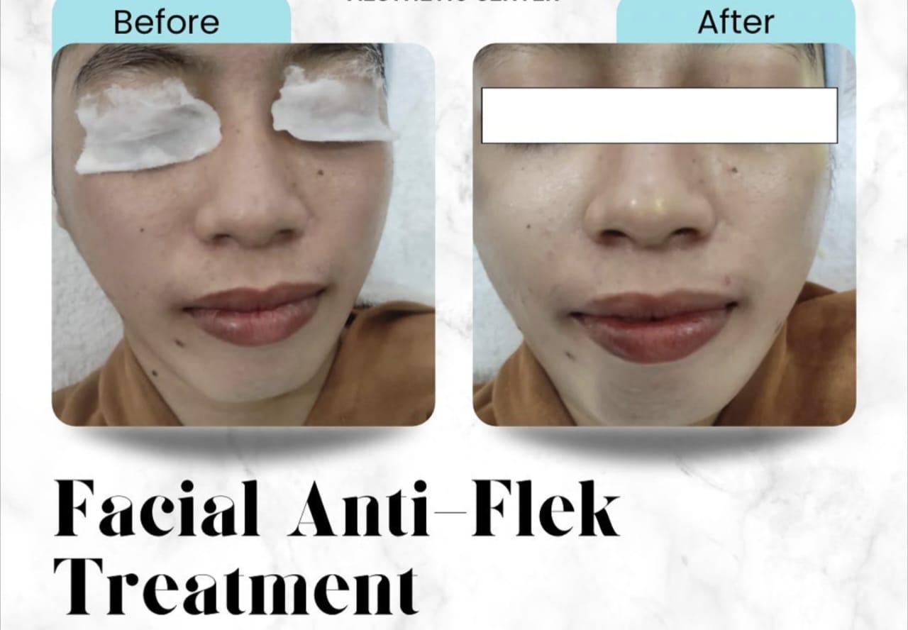 Ternyata, Inilah 4 Produk Perawatan Kulit yang Efektif untuk Mengatasi Flek Hitam dan Mencerahkan Wajah!