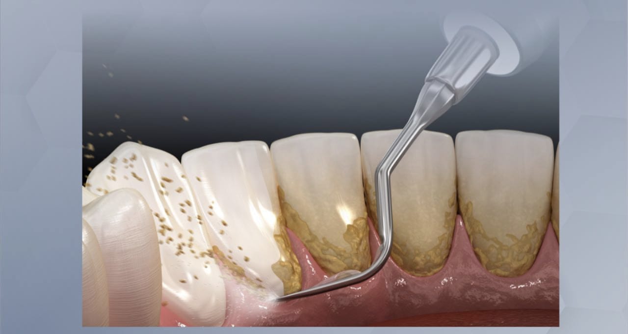 Tips Ampuh Atasi Plak Gigi Membandel ala Jepang Hanya dengan Menggunakan Satu Jenis Minuman, Tanpa Lemon
