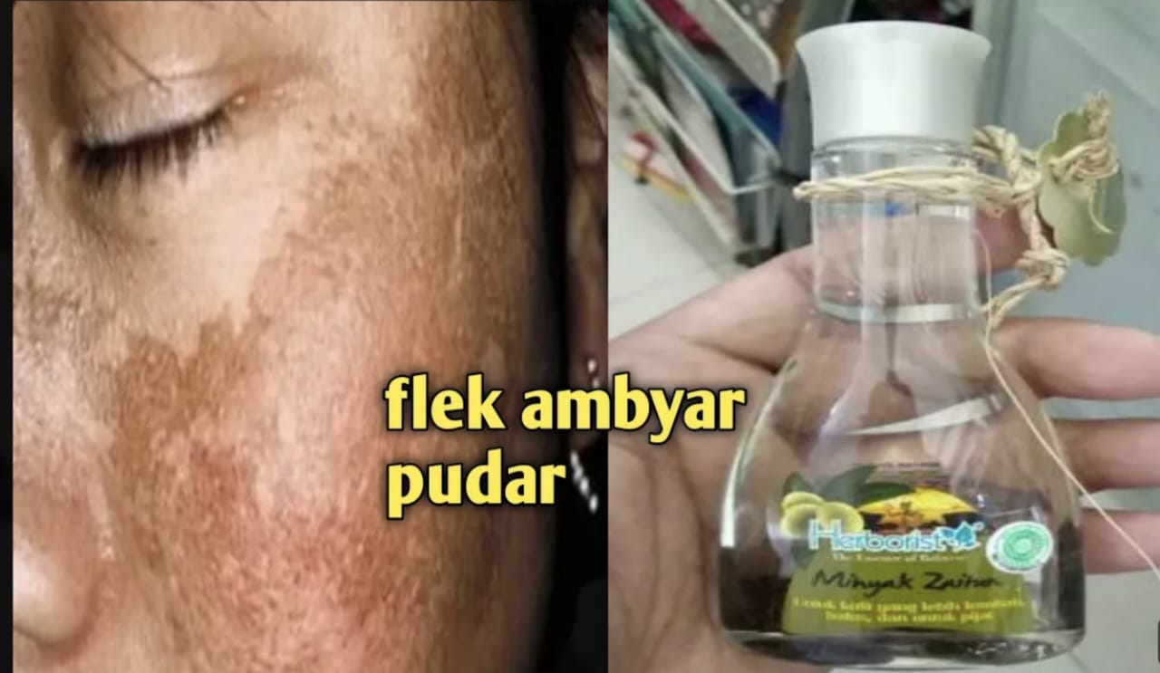 Tips Menghilangkan Flek Hitam dengan Masker Lidah Buaya dan Minyak Zaitun, Berikut 3 Cara Membuat Campurannya!