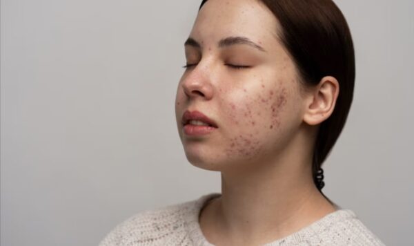 Lidah Buaya, Mitos atau Fakta? Apakah Bisa Menghilangkan Flek Hitam di Muka?