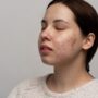 Lidah Buaya, Mitos atau Fakta Apakah Bisa Menghilangkan Flek Hitam di Muka