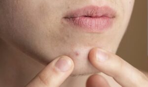 Super Tetra untuk Jerawat, Apakah Bisa? Ini Dia Jawabannya!