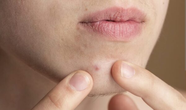 Super Tetra untuk Jerawat, Apakah Bisa? Ini Dia Jawabannya!