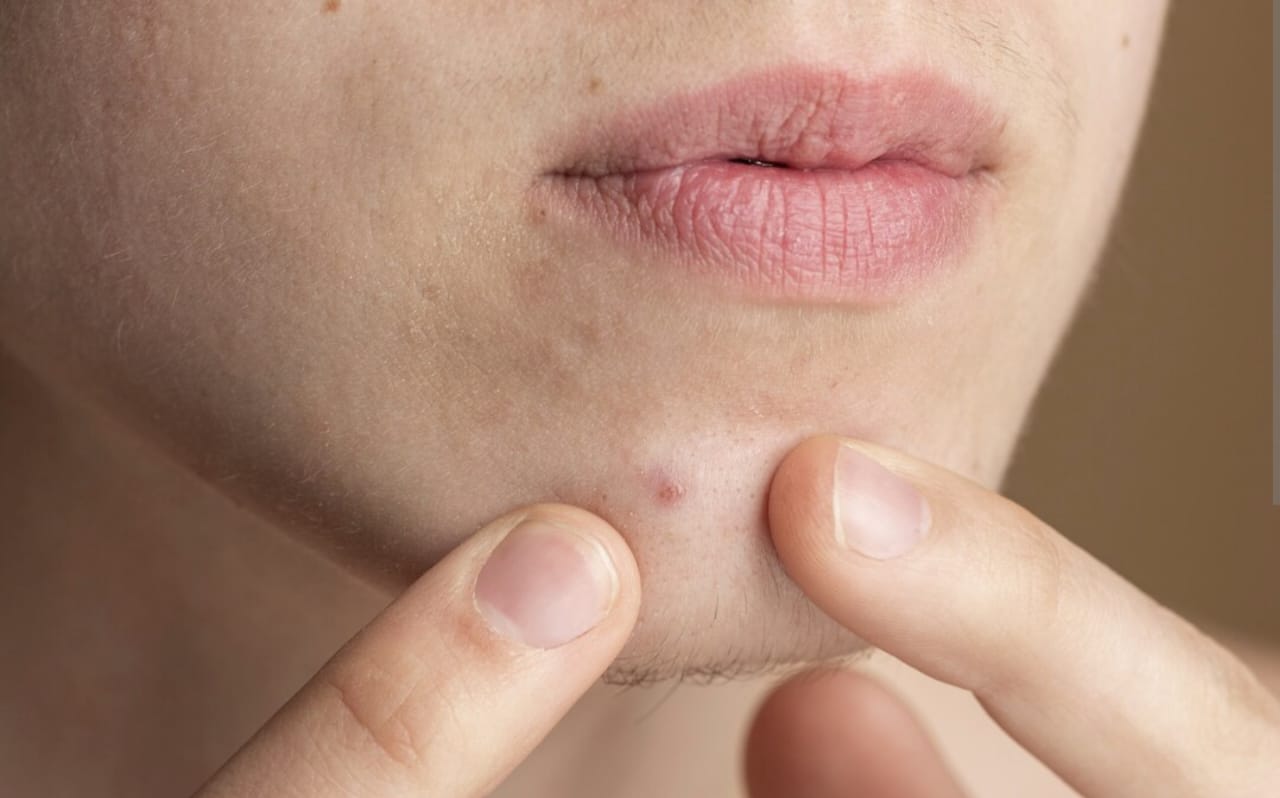 Super Tetra untuk Jerawat