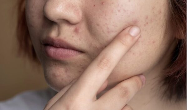 Apakah Darah Jerawat Membatalkan Wudhu? Ternyata Ini Dia Faktanya!