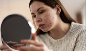 Mitos Jerawat Ada yang Kangen, Apakah Beneran?