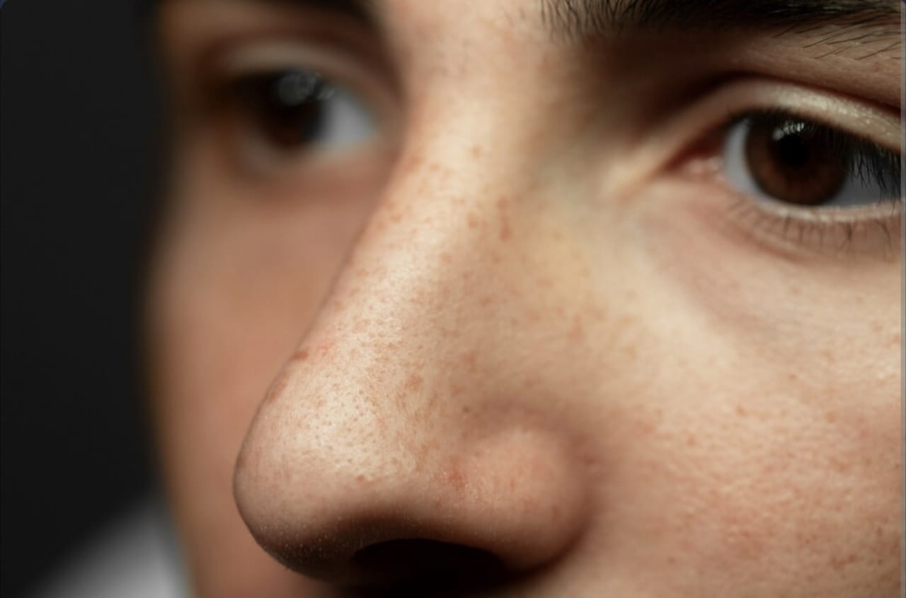 Cara Ngilangin Flek Hitam di Hidung