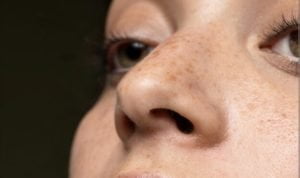 14 Cara Ngilangin Flek Hitam di Hidung dan Wajah dengan Mudah