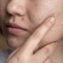 Cara Menghilangkan Flek Hitam dalam 1 Jam secara Alami