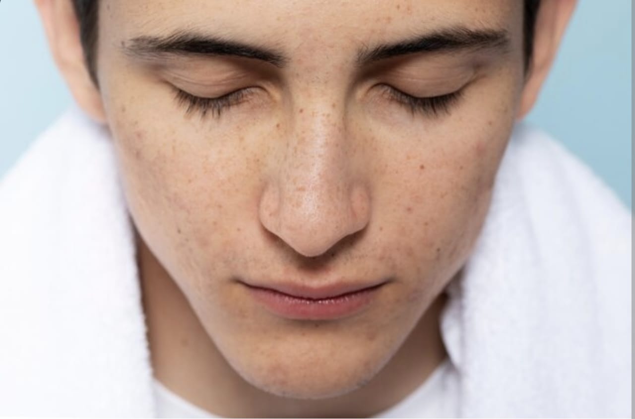 Cara Menghilangkan Flek Hitam di Bawah Hidung Seperti Kumis
