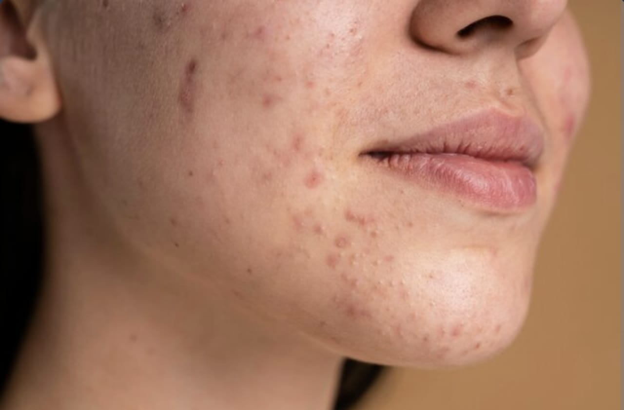 Cara Menghilangkan Bintik Hitam Bekas Jerawat di Wajah