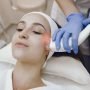 Biaya Laser Flek Hitam di Natasha