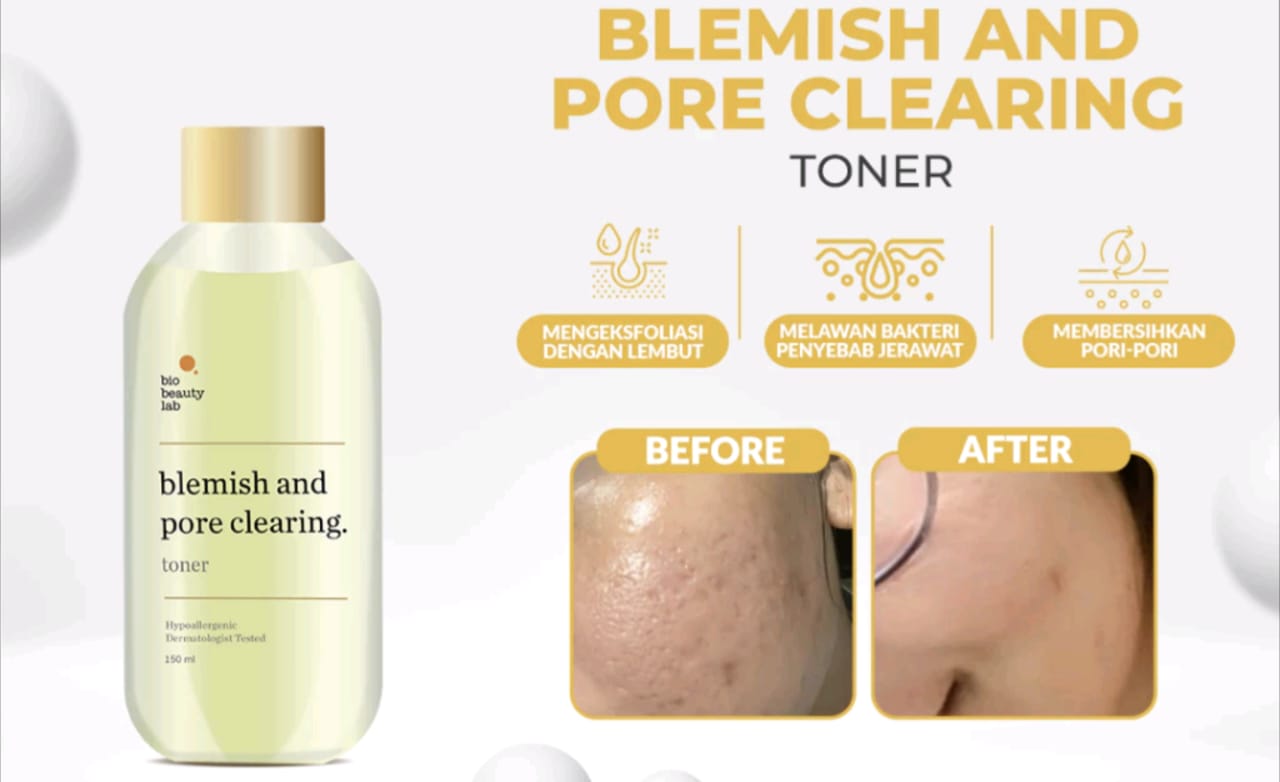 Skincare untuk Menghilangkan Jerawat dan Bekasnya