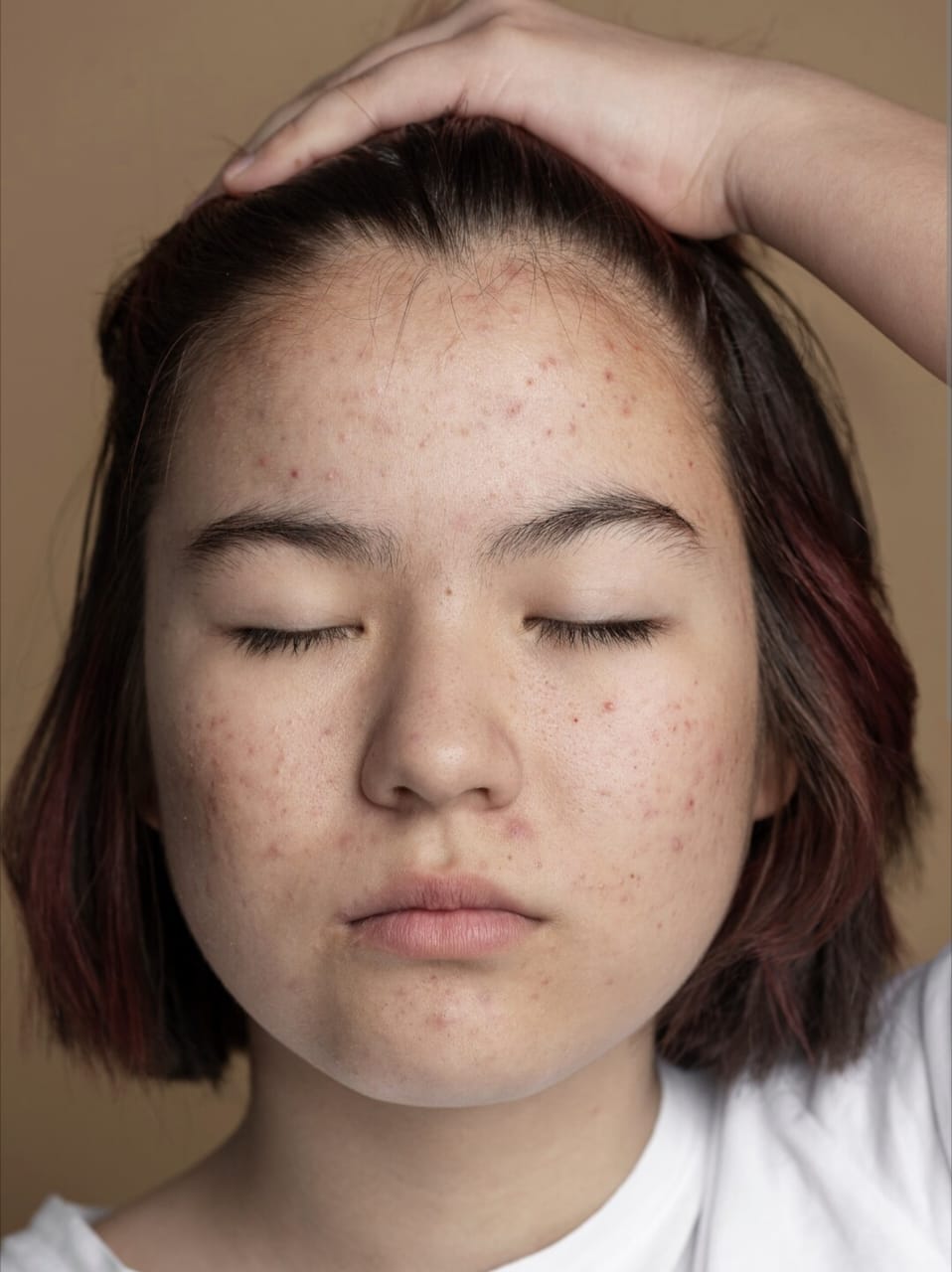 Bintik Bintik Merah di Wajah Tapi Bukan Jerawat