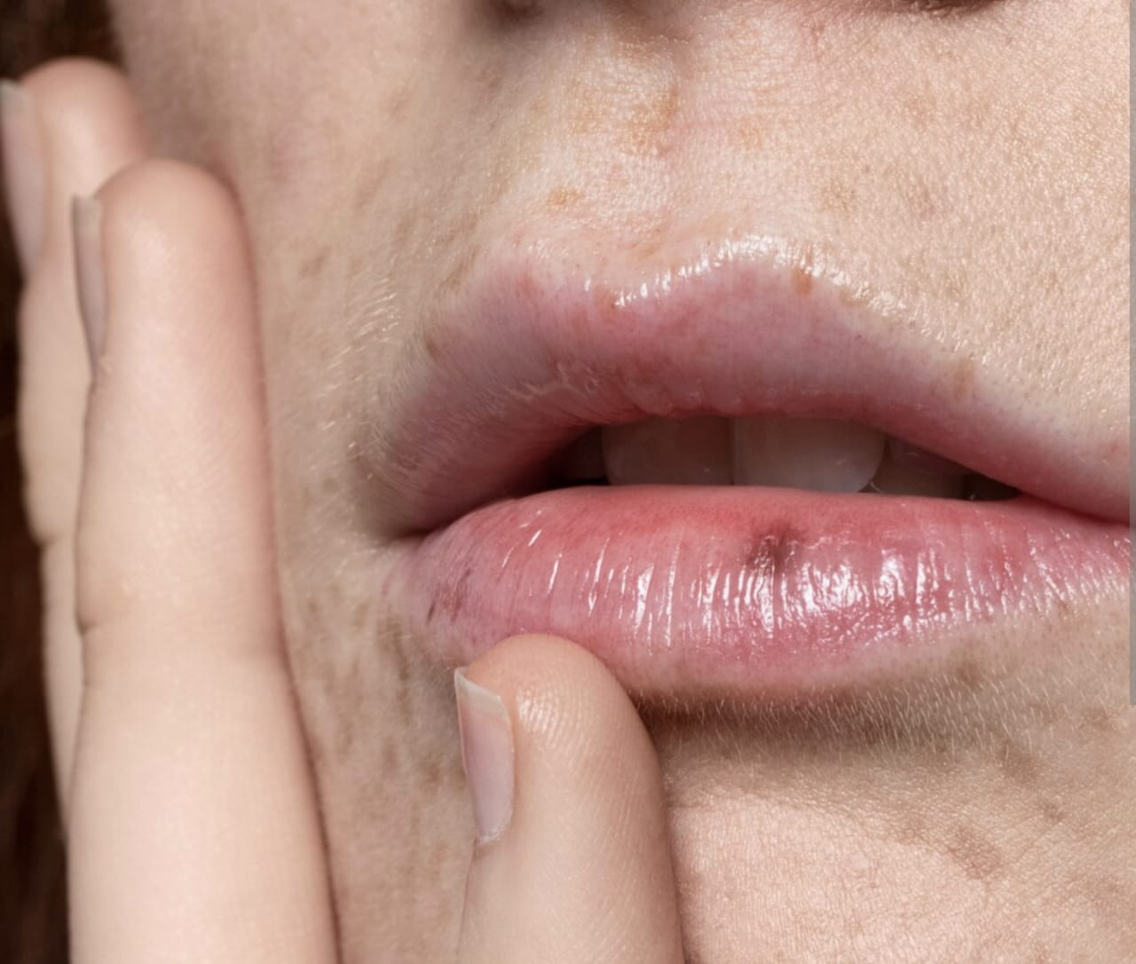 Bintik Putih di Bibir Seperti Jerawat