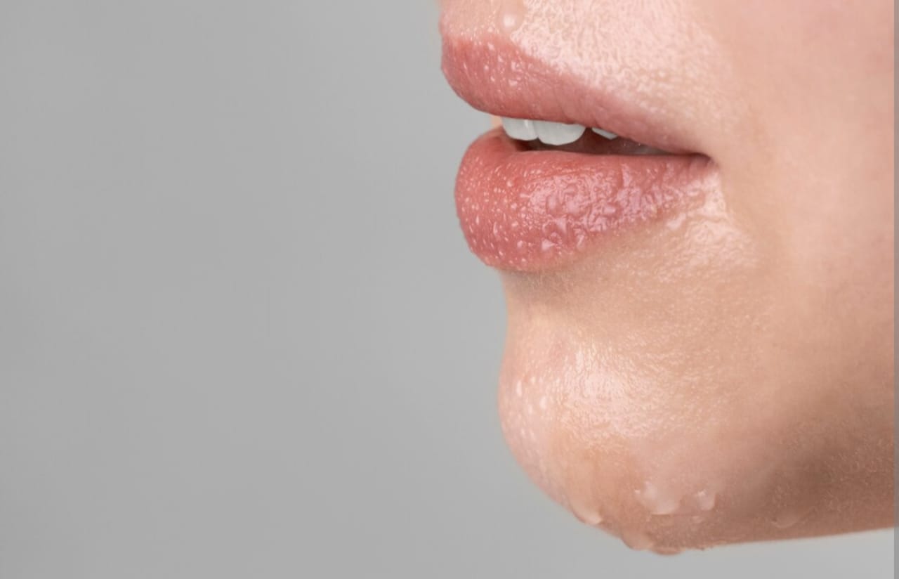 Bintik Putih di Bibir Seperti Jerawat