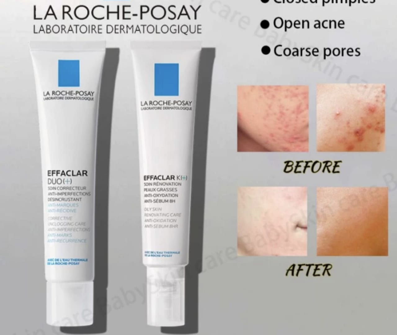 Moisturizer yang Cocok untuk Kulit Berminyak dan Berjerawat