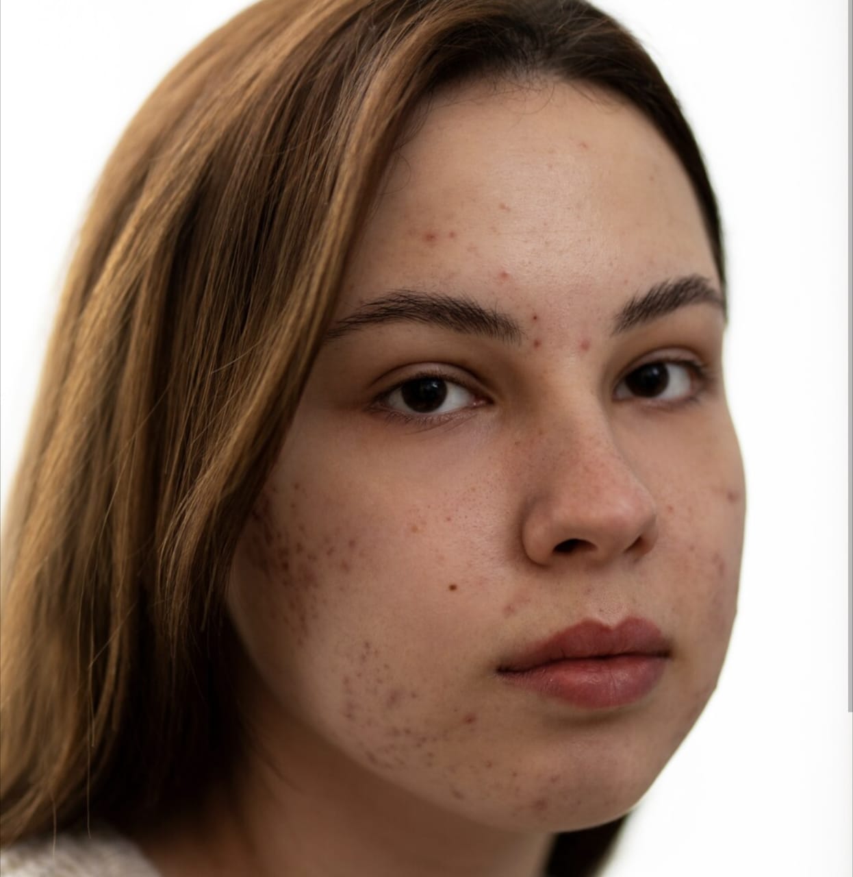 Cara Mengatasi Bercak Putih di Wajah