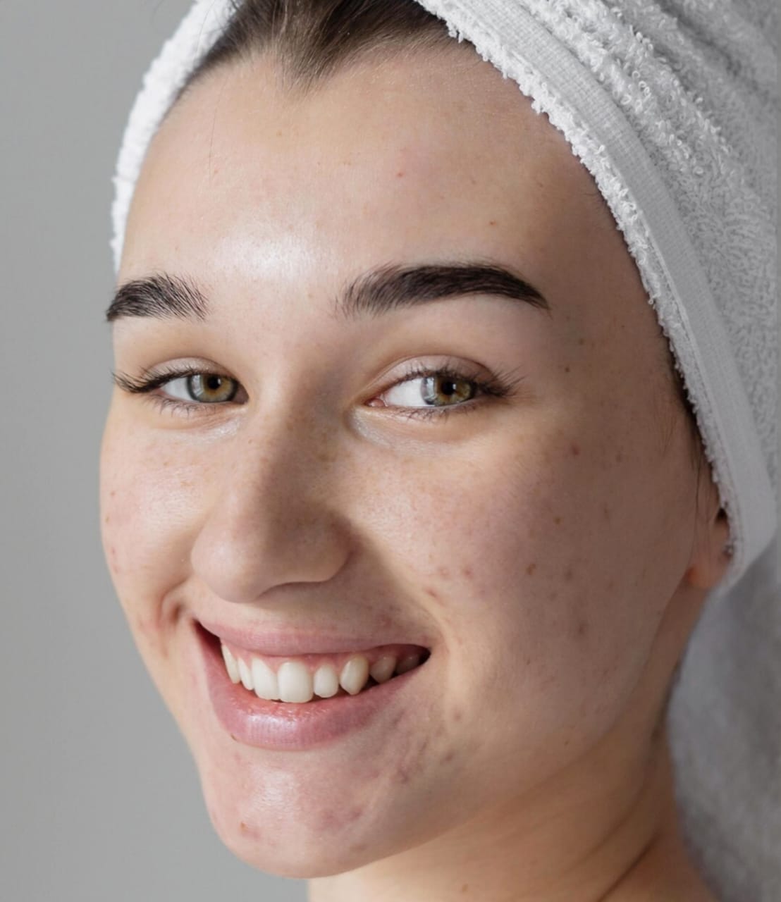 Cara Mengatasi Bercak Putih di Wajah