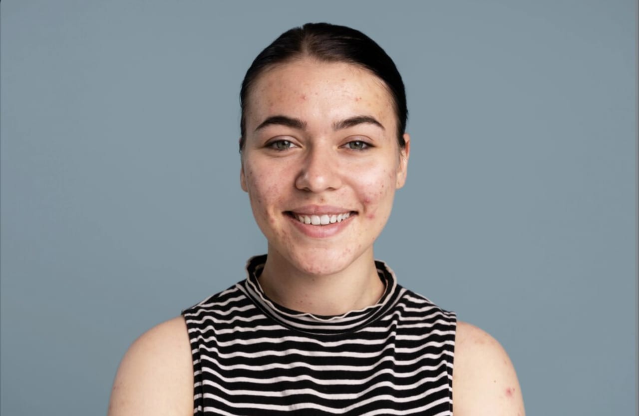 Cara Mengatasi Bercak Putih di Wajah