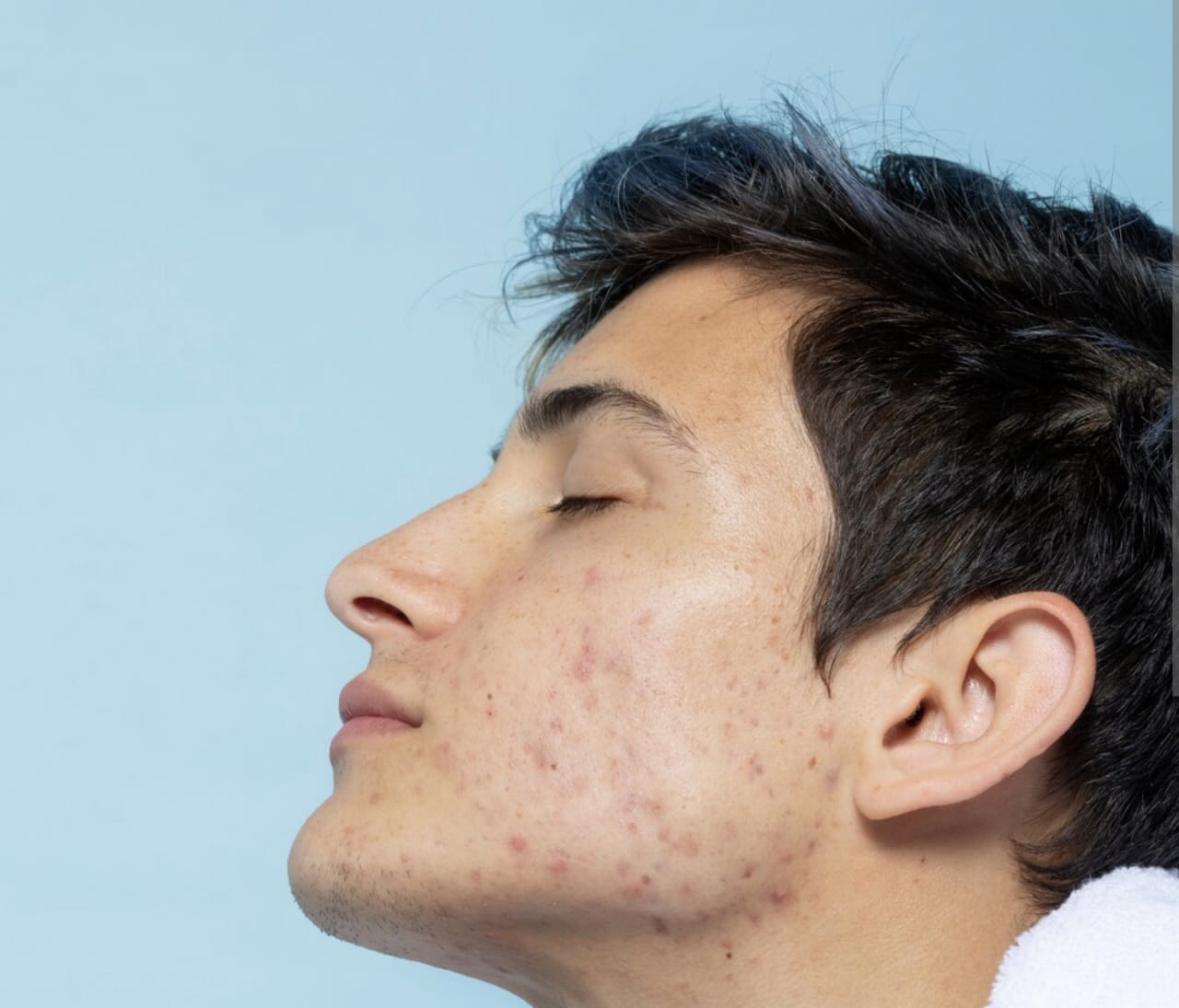 Cara Mengatasi Bercak Putih di Wajah