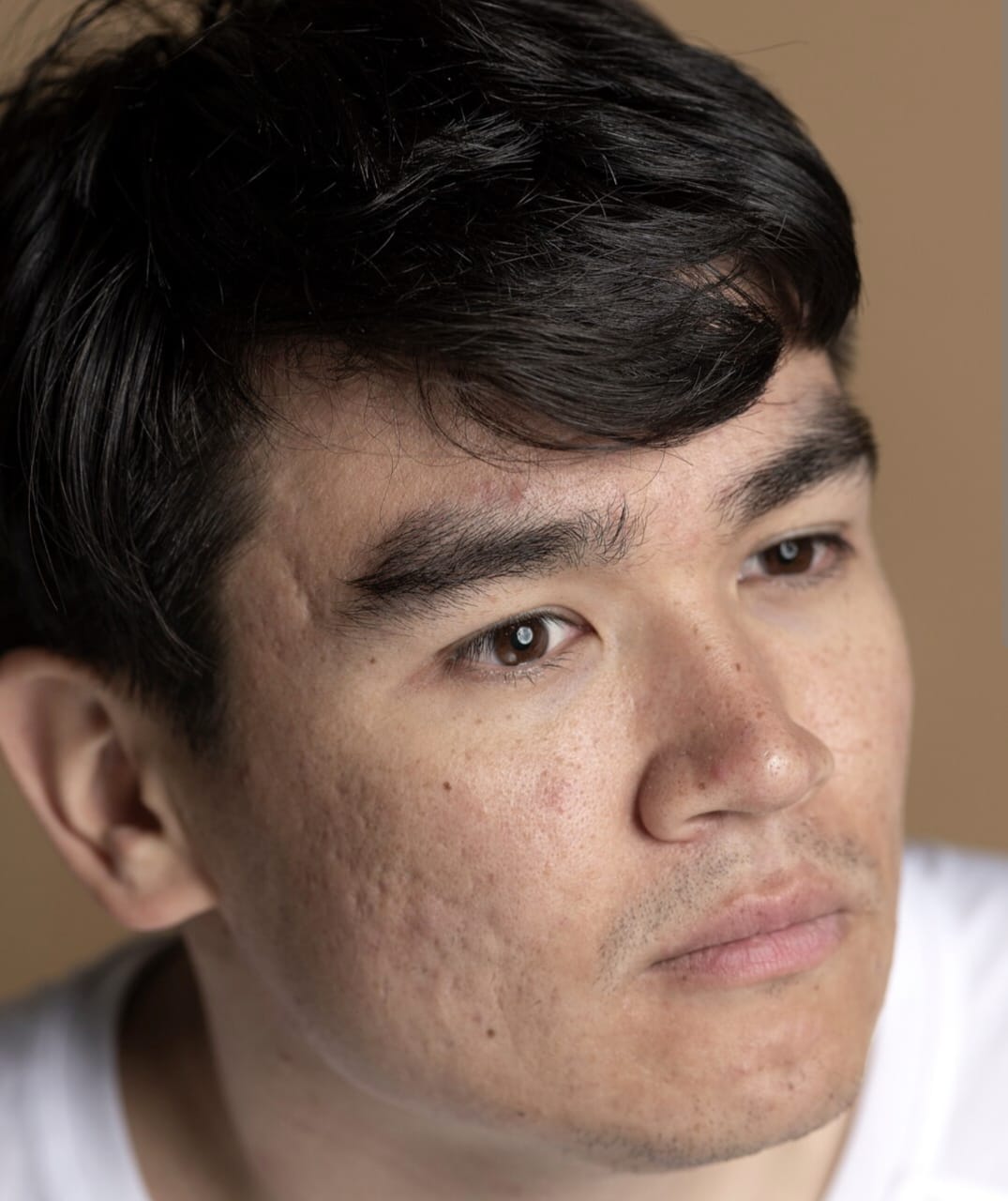 Cara Mengatasi Bercak Putih di Wajah