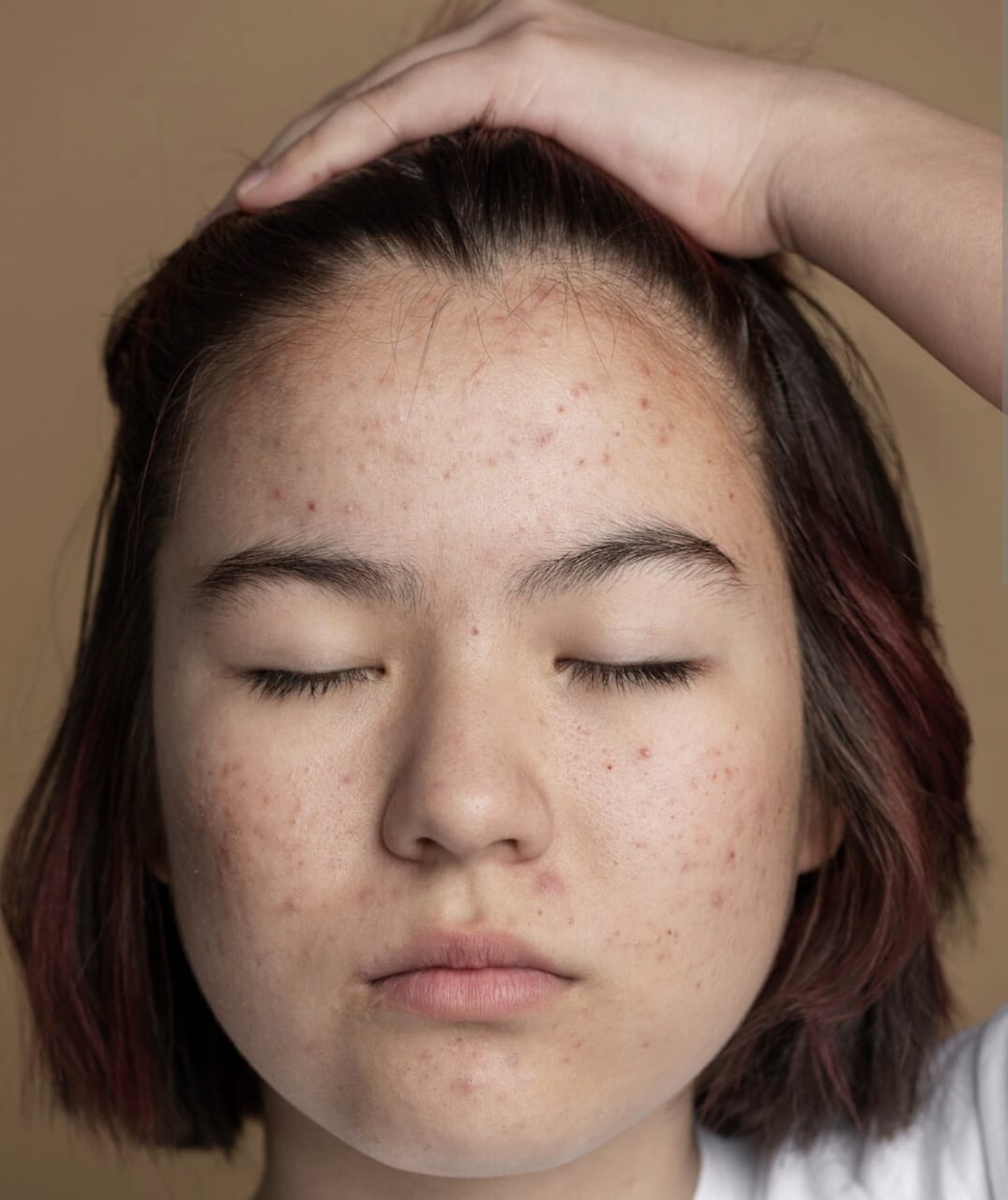 Cara Mengatasi Bercak Putih di Wajah