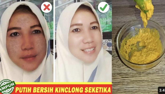 5 Cara Menghilangkan Flek Hitam di Usia 40 Tahun Secara Alami Tanpa Ribet, dan Hasilnya Terbukti!
