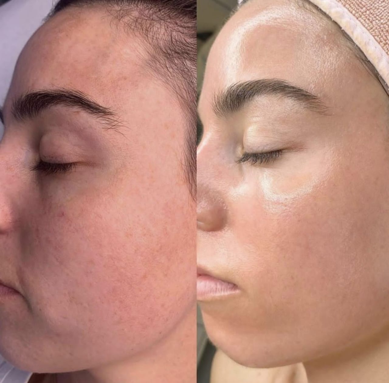 Cara Menghilangkan Flek Hitam di Wajah Dalam Satu Malam